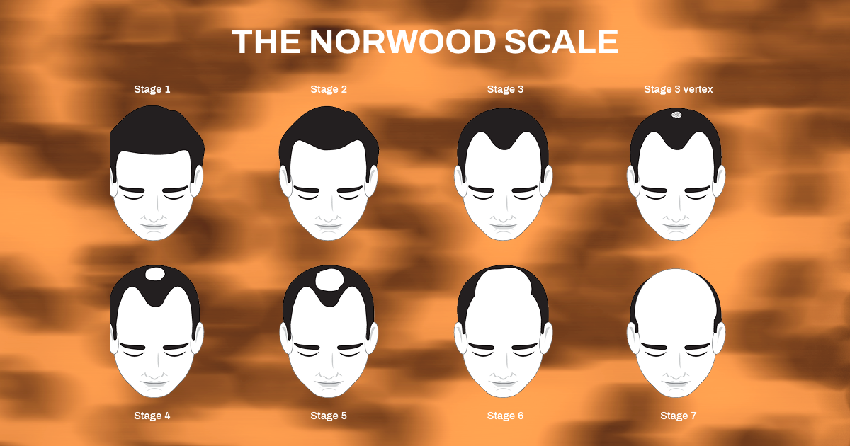 Norwood Scale illustrating seven stages of male pattern baldness progression.